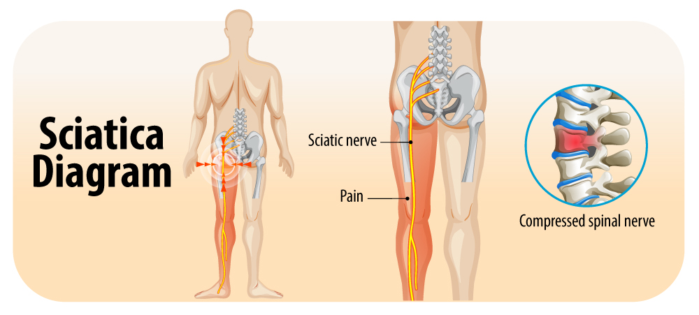 Sciatica Diagram