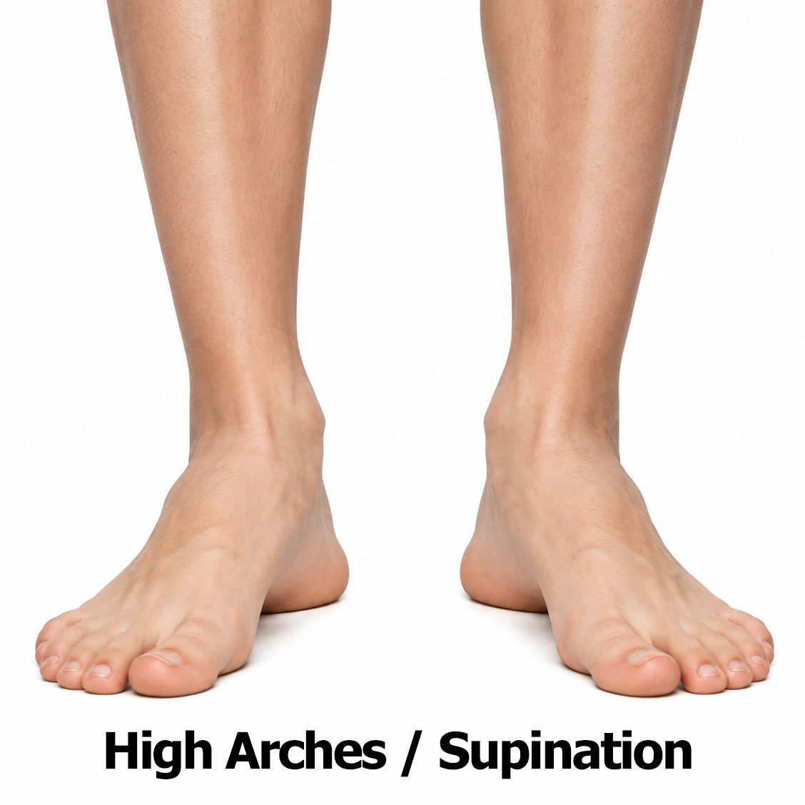 High-Arches-Supination-Feet | The FootLab Custom Orthotics | St Paul Minneapolis MN High Arches / Supination Feet